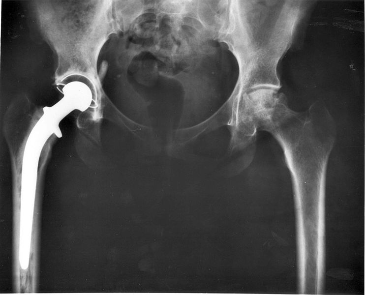 An xray photo of a patient&rsquo;s right hip joint that has been replaced by a metal head and a plastic cup.